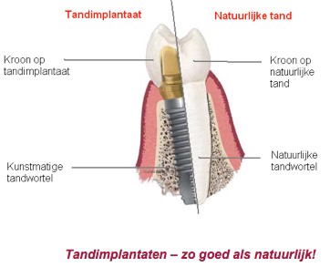 tandimplantaten tandartspraktijk waterval almere