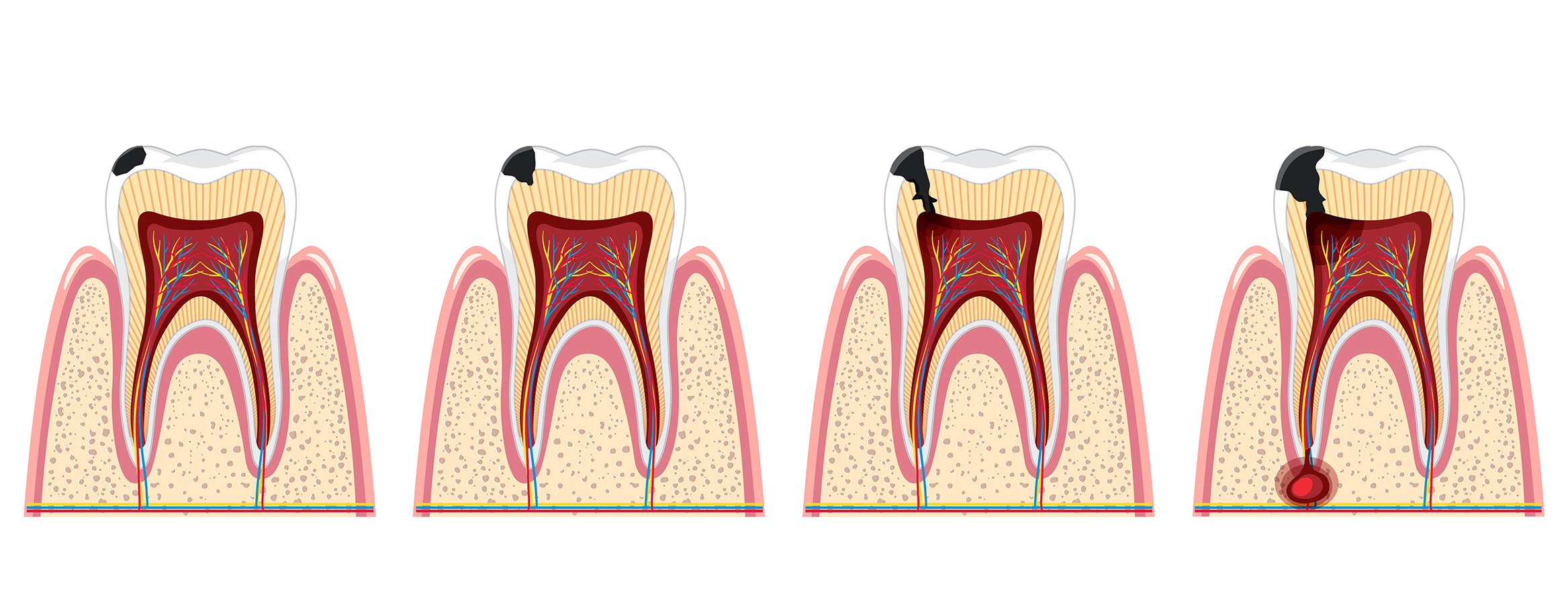 Pulpa, het weefsel in een tand